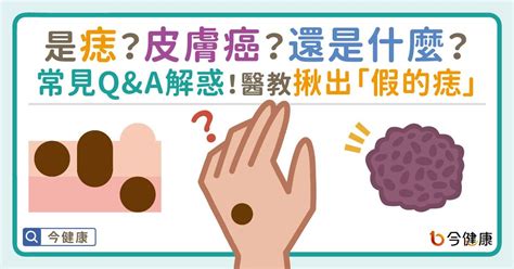 右耳朵突然長痣|是痣or皮膚癌？醫「1張圖秒對照」 長這2部位最危險